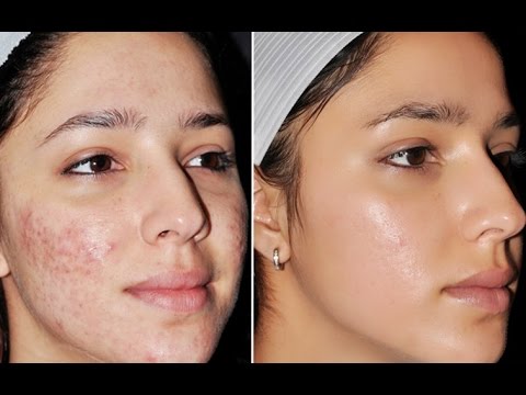 Top 3 DIY Homemade Acne Face Masks | How to Get Rid of Acne & Acne