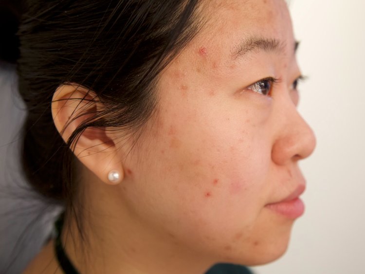 Acne mistakes that can make breakouts worse - INSIDER