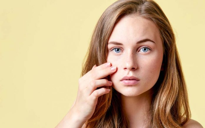 7 Effective Natural Remedies for Teen Acne