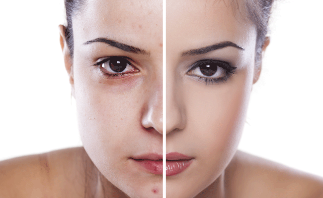 14 Natural Ways To Get Rid of Acne Forever! - Indiatimes.com