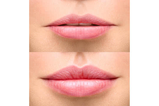 How Do I Make Thin Lips Look Fuller?