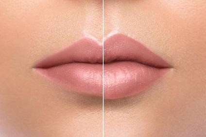 Best Approaches to Natural Looking, Fuller Lips | Renew Medispa